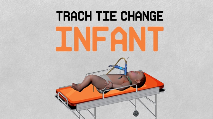 Trach Tie Change – Infant