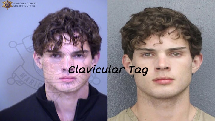 Clavicular Tag